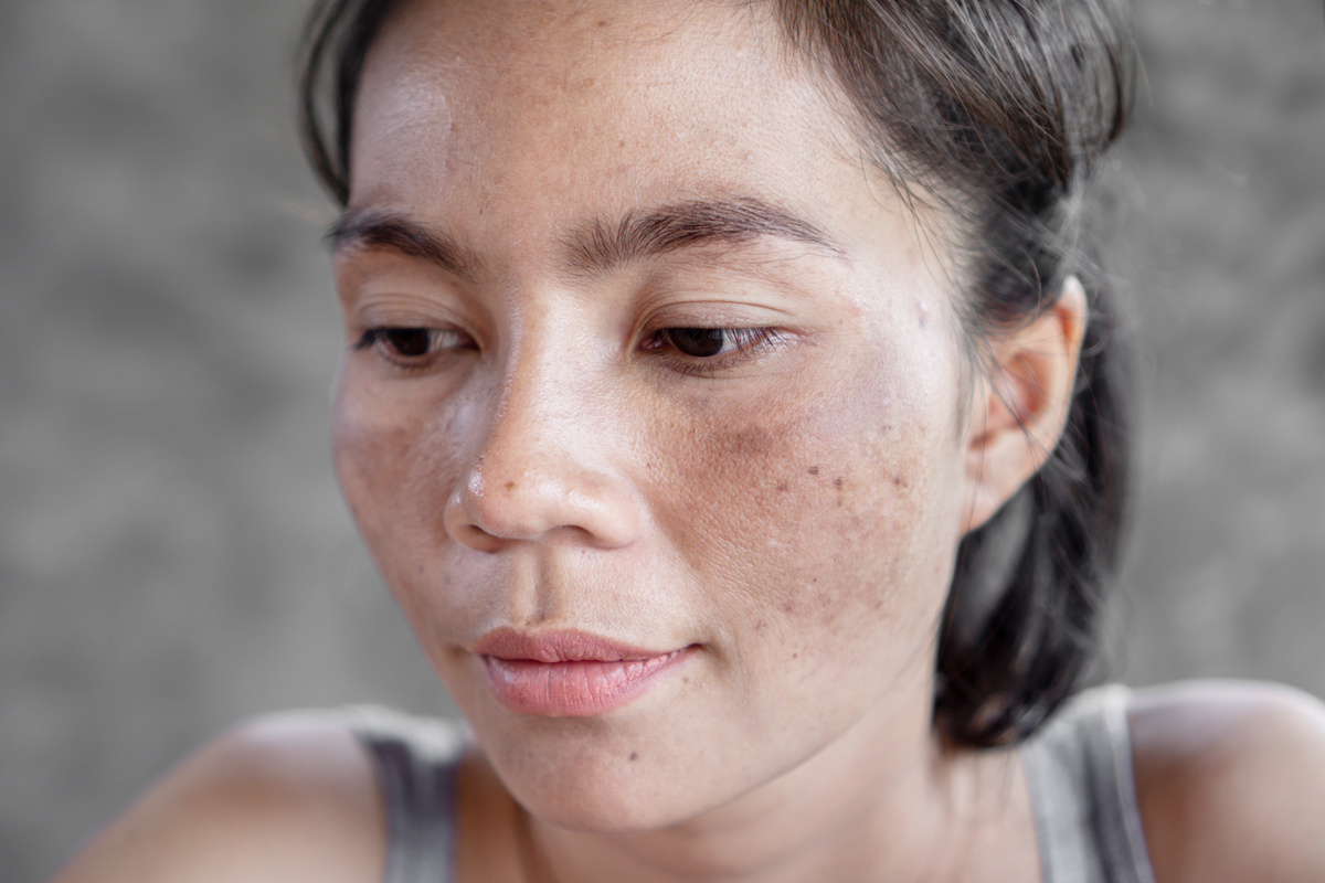 asian woman have problem with  melasma and sun damage on face